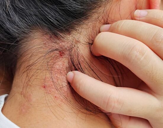 how to treat scalp psoriasis