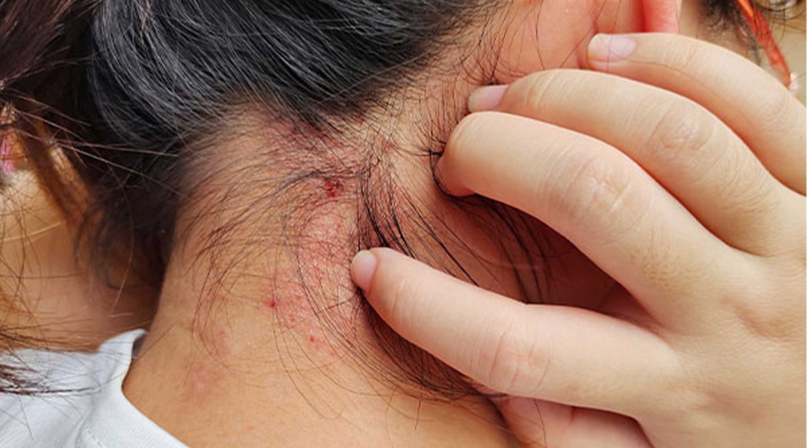 how to treat scalp psoriasis