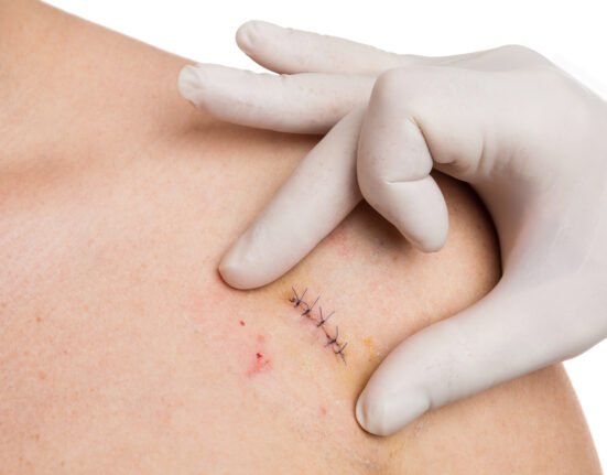 doctors hands checking stitches after mold