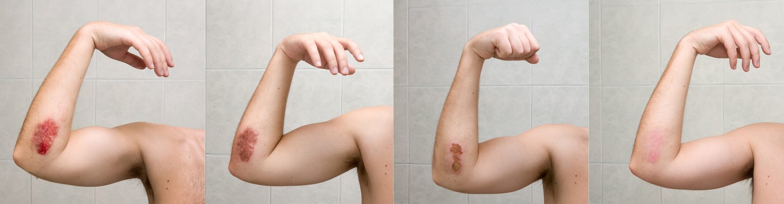 Wound healing process XXL bruises