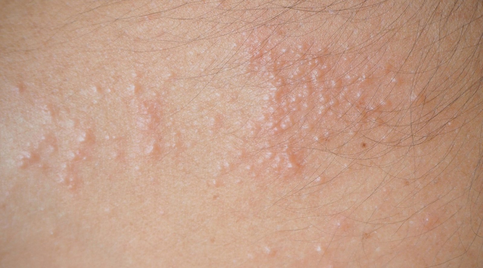 Heat Rash Real Life Heat Rash vs Hives: What’s the Difference? GWS Wellness