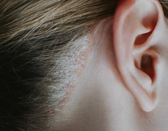 dermatitis dan psoriasis kulit kepala