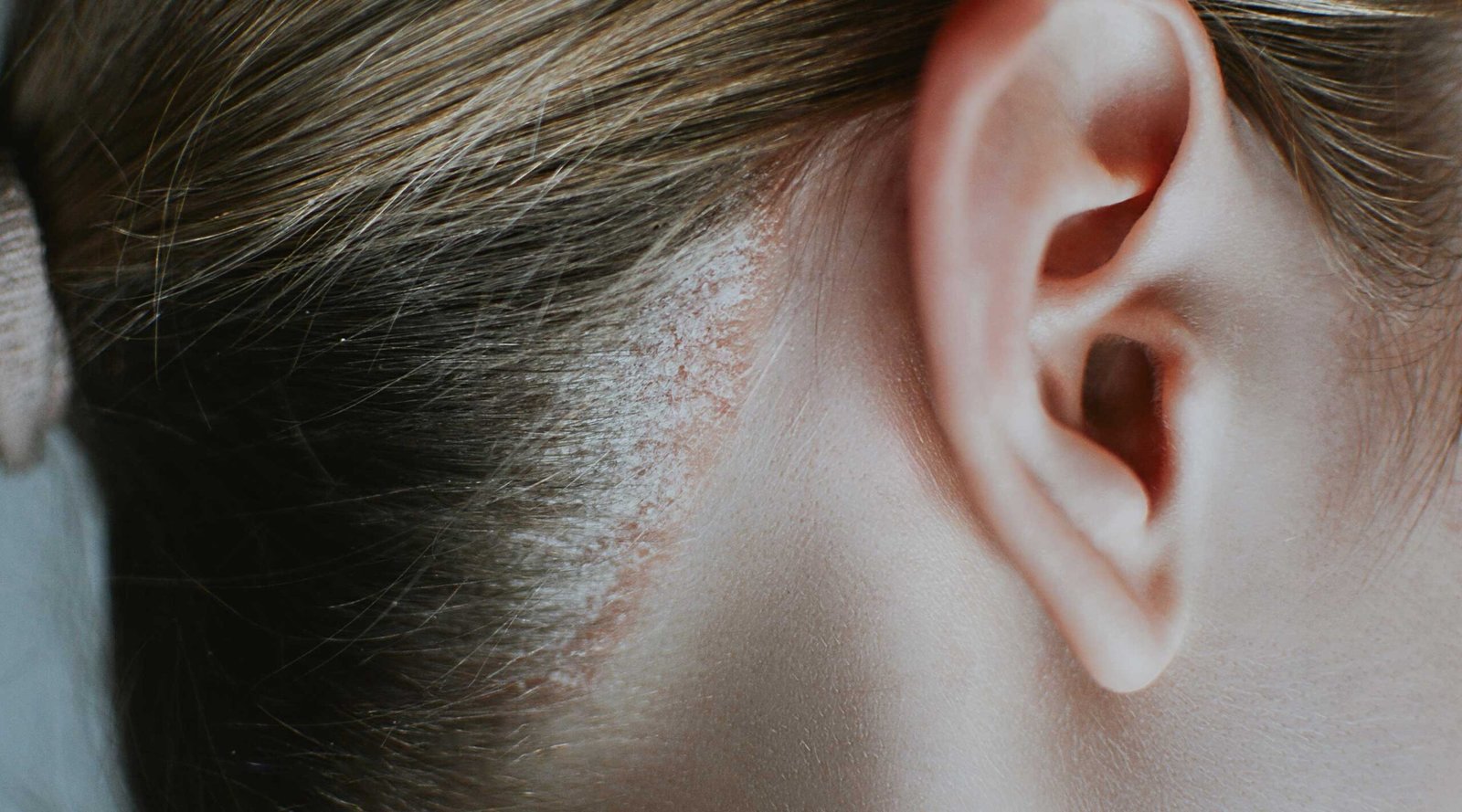 dermatitis dan psoriasis kulit kepala