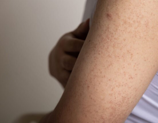 keratosis pilaris