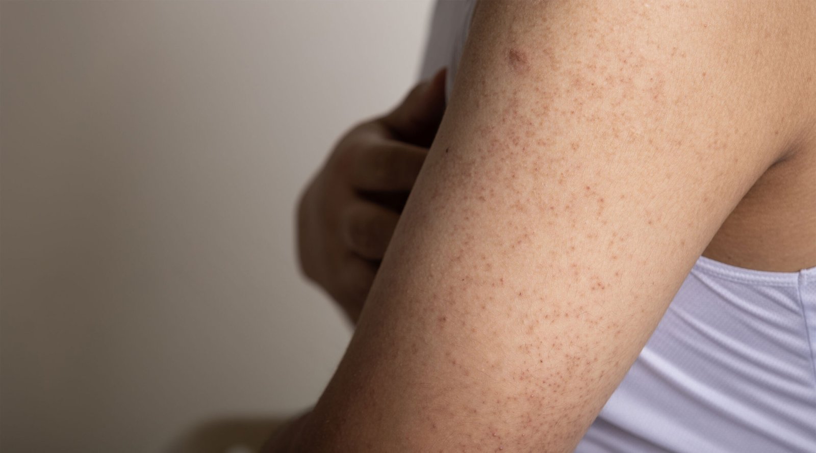 keratosis pilaris