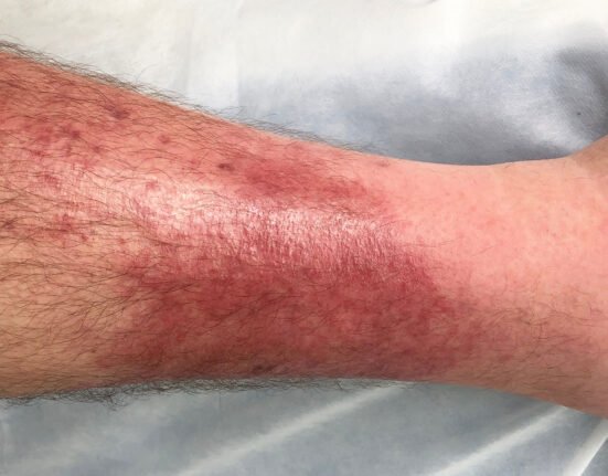 skin cellulitis