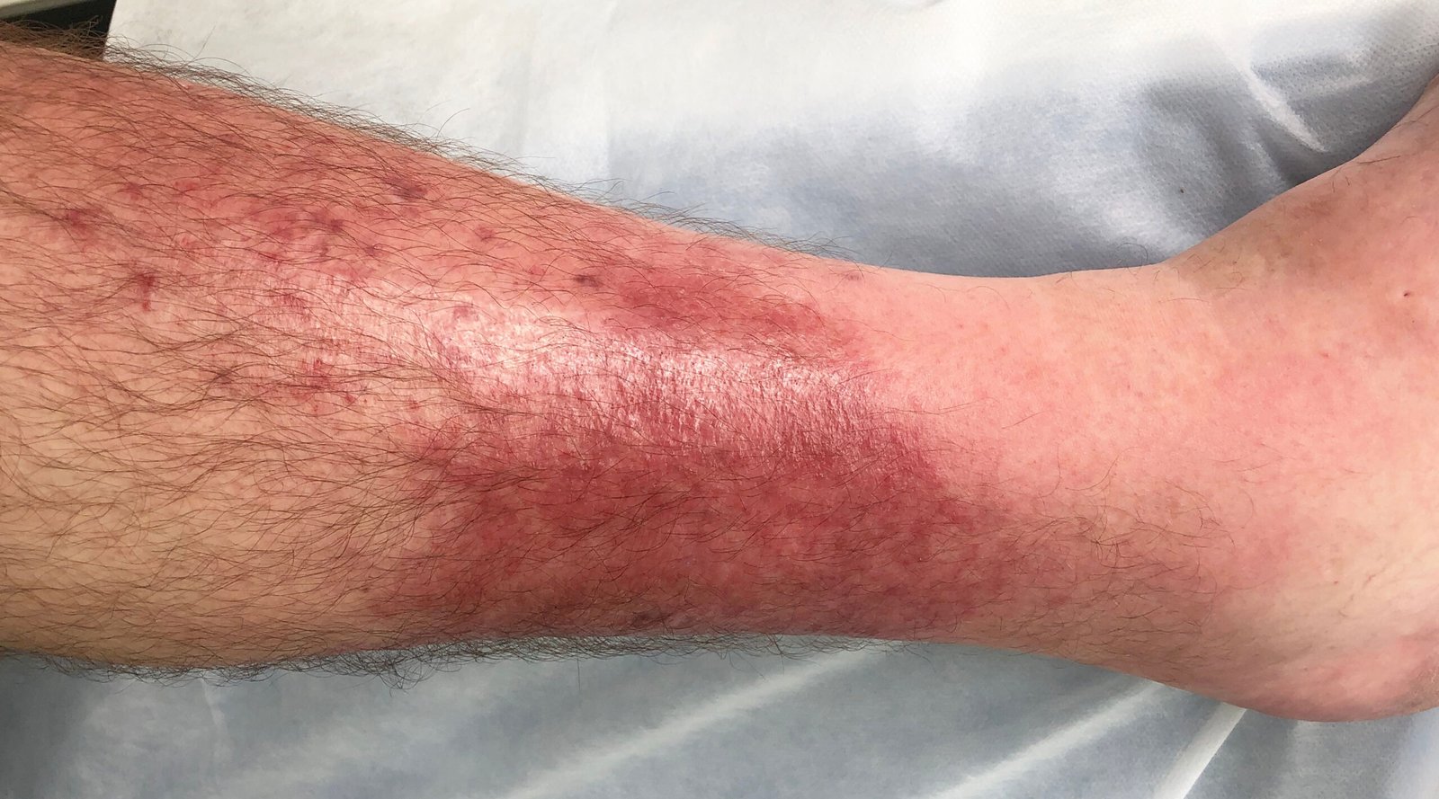 skin cellulitis