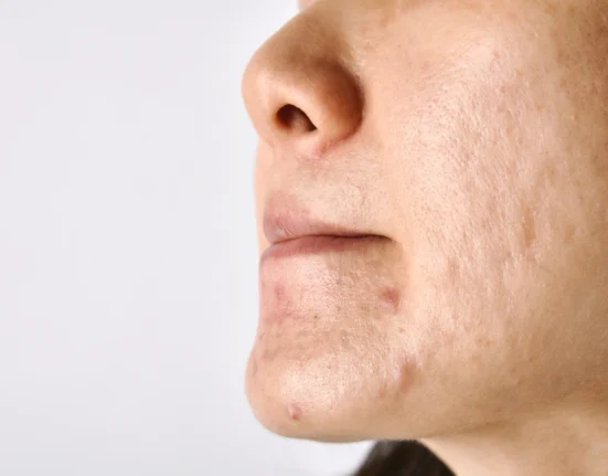 Close-up wajah dengan bekas jerawat membandel di pipi dan dagu, menunjukkan pentingnya perawatan bekas luka yang tepat