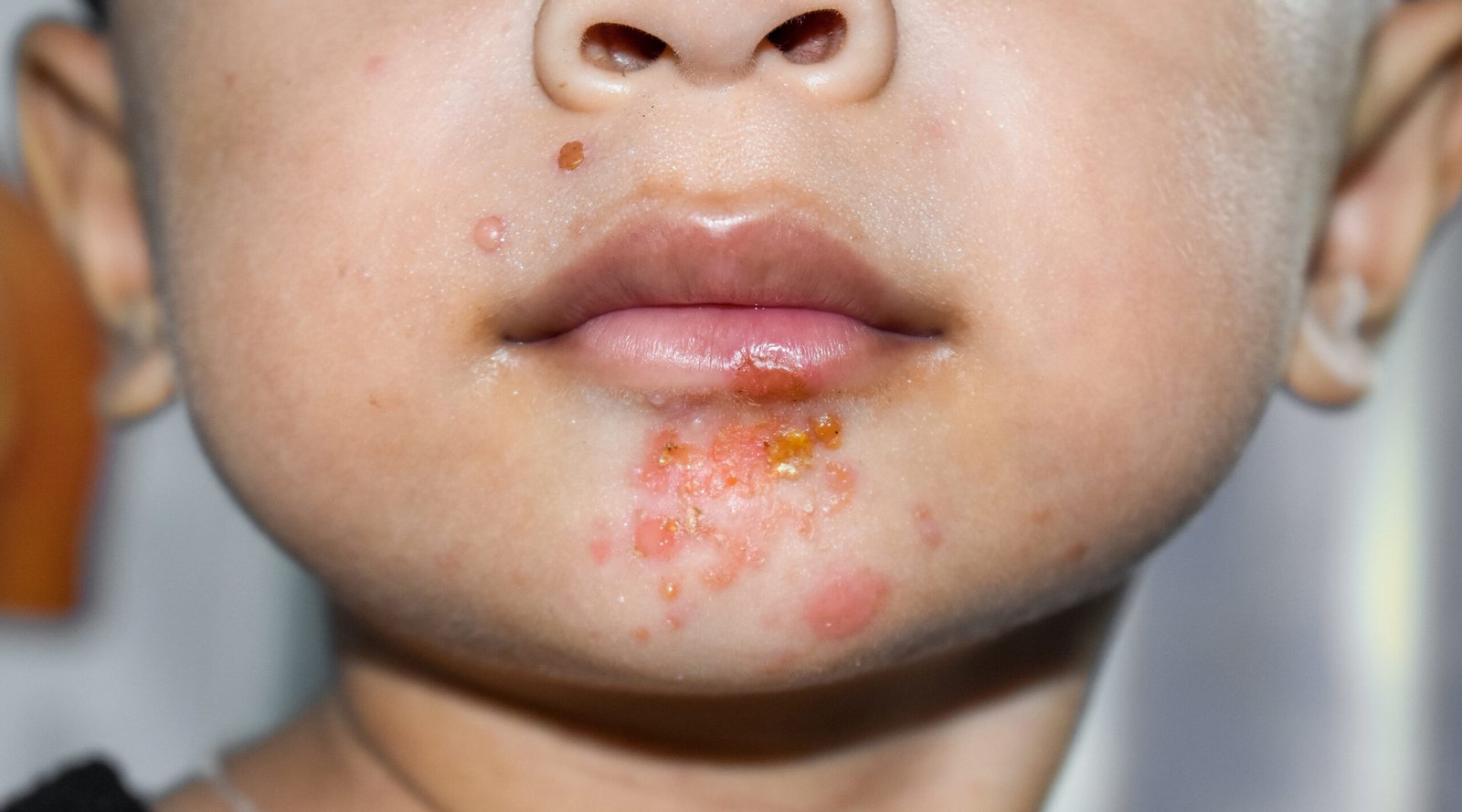 impetigo