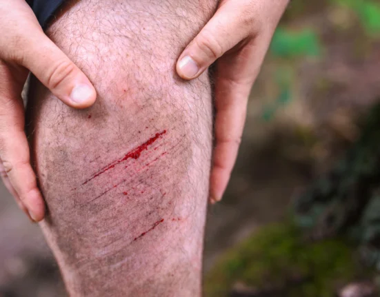 Luka gores di kaki pria akibat aktivitas luar ruangan di alam.