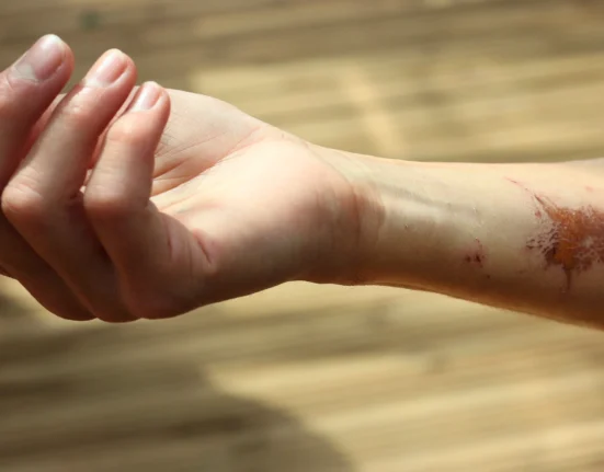 Luka bakar ringan pada lengan dengan kemerahan dan kulit teriritasi, contoh kondisi luka bakar dangkal yang dapat dirawat dengan aman di rumah.