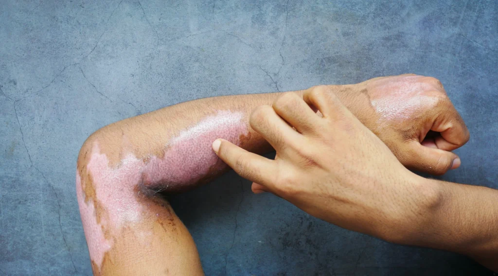 Area luka bakar yang sedang dalam proses penyembuhan dengan kulit baru terbentuk, menunjukkan pentingnya perawatan luka bakar yang lembut dan tepat.