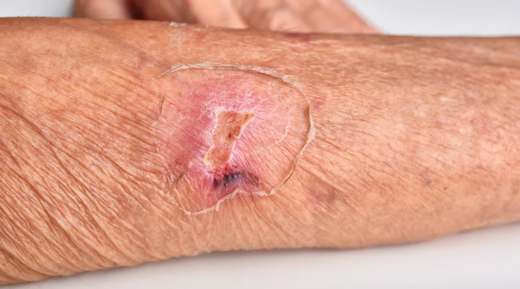 Kulit lansia yang mengelupas dengan luka yang sedang dalam proses penyembuhan.